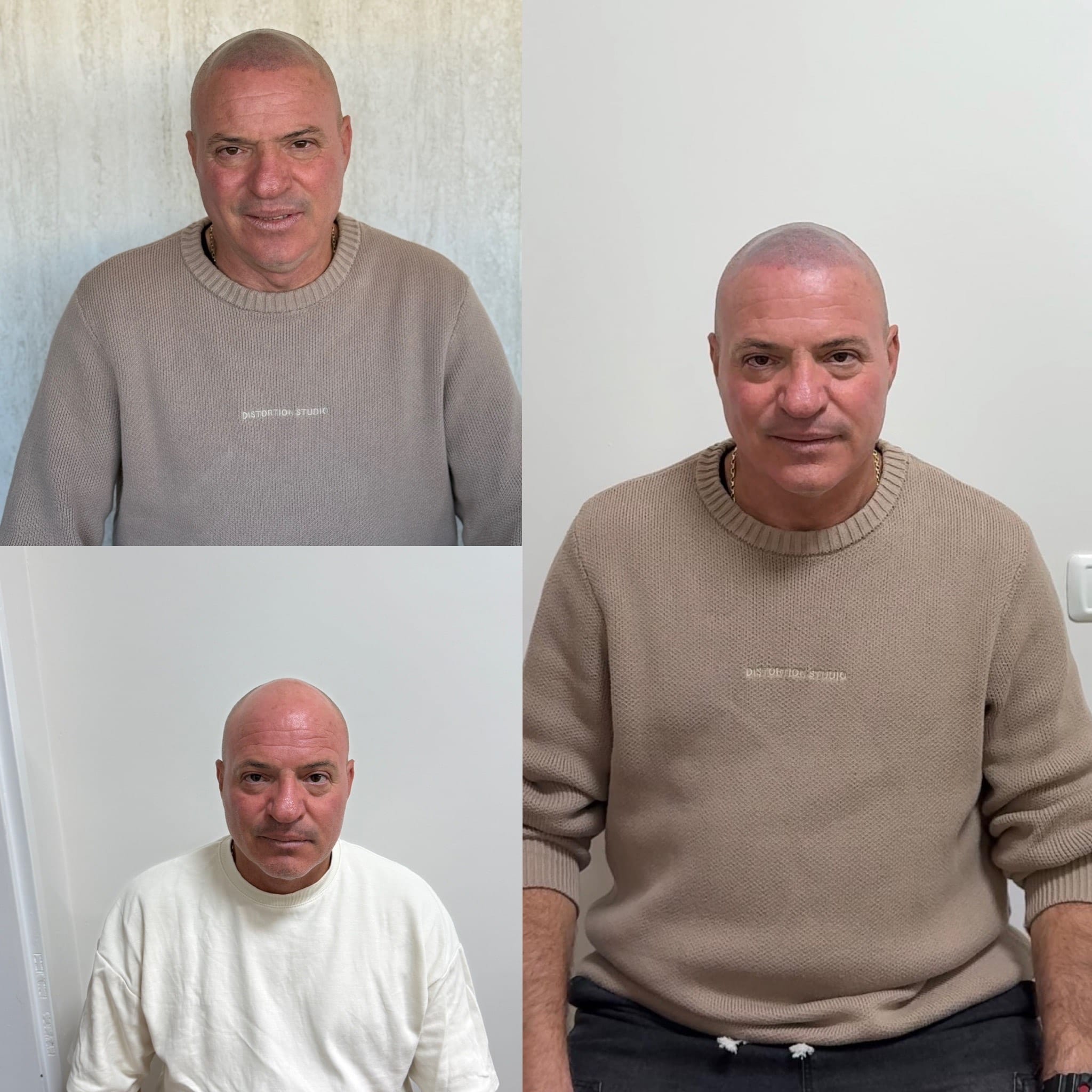 שיפור קו שיער בצורה טבעית